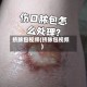 挤脓包视频(挤脓包视频)