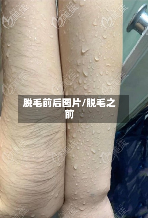 脱毛前后图片/脱毛之前-第1张图片