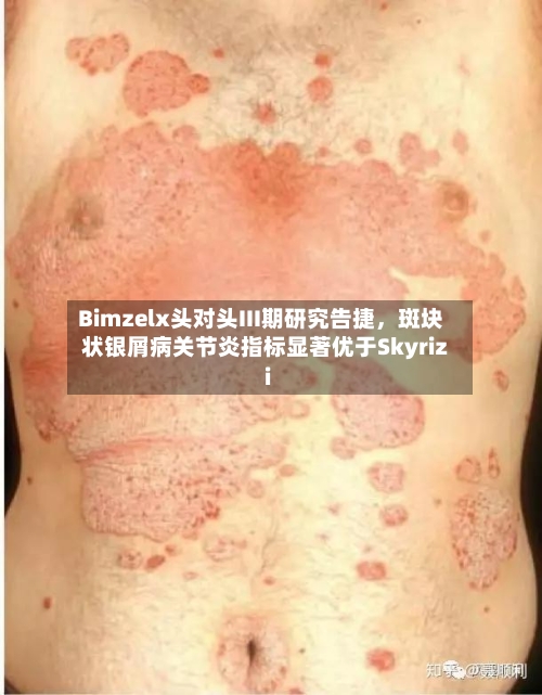 Bimzelx头对头III期研究告捷，斑块状银屑病关节炎指标显著优于Skyrizi-第2张图片