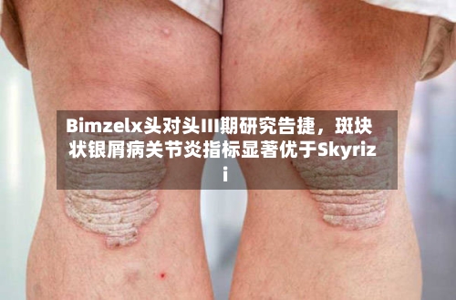 Bimzelx头对头III期研究告捷，斑块状银屑病关节炎指标显著优于Skyrizi-第1张图片